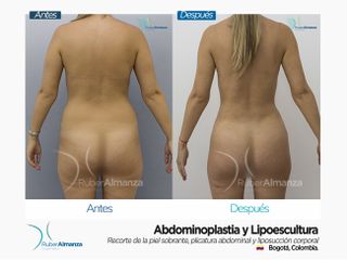 Abdominoplastia y Liposucción Antes y después 