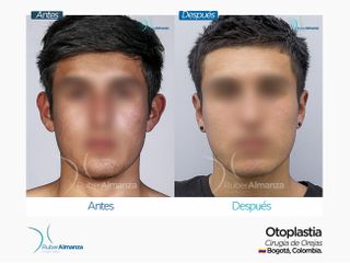 Antes y después Otoplastia