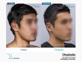 Antes y después Otoplastia 