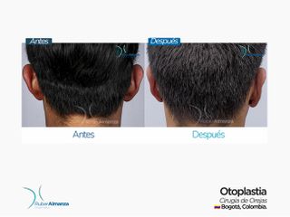 Antes y después Otoplastia