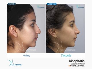 Rinoplastia Mujer