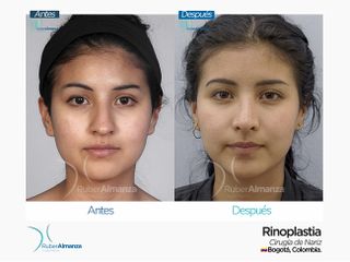 Rinoplastia Mujer