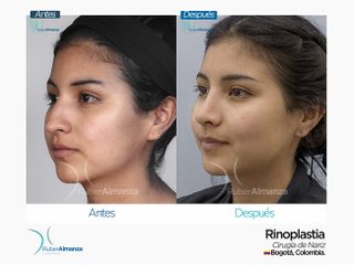 Rinoplastia Mujer