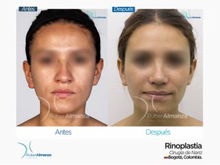 Rinoplastia Mujer 