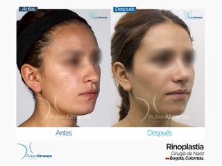 Rinoplastia Mujer