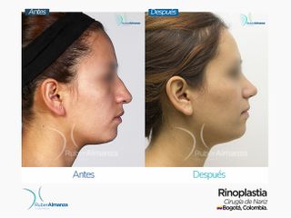 Rinoplastia Mujer