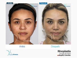 Rinoplastia Mujer