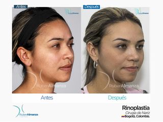 Rinoplastia Mujer