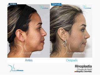 Rinoplastia Mujer