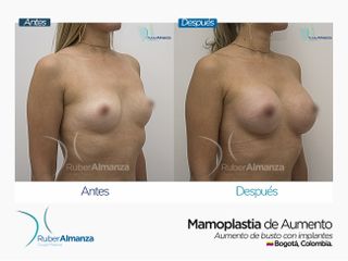Mamoplastia de aumento