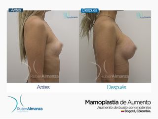 Mamoplastia de aumento