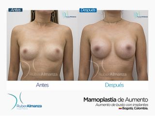 Mamoplastia de aumento 