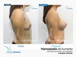 Mamoplastia de aumento