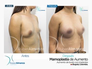 Mamoplastia de aumento