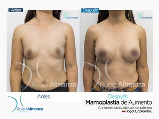 Mamoplastia de aumento