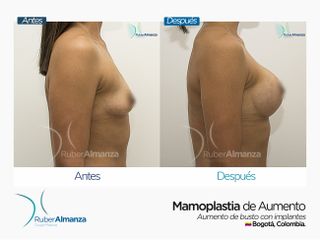 Mamoplastia de aumento