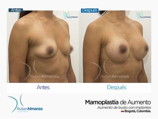 Mamoplastia de aumento