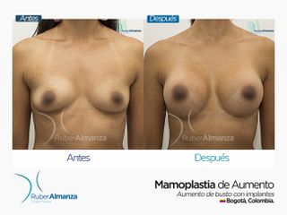 Mamoplastia de aumento