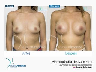 Mamoplastia de aumento