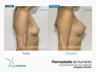 Mamoplastia de aumento