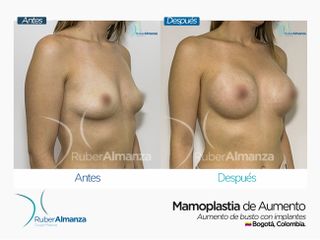 Mamoplastia de aumento