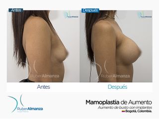 Mamoplastia de aumento