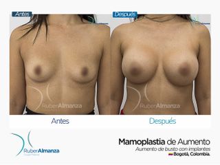 Mamoplastia de aumento