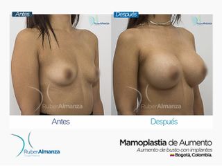 Mamoplastia de aumento 
