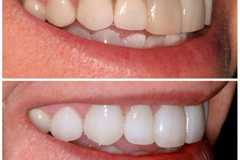 Blanqueamiento dental antes y después - 410477