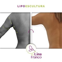 Lipoescultura en Brazos y Espalda alta - Dra. Lina Franco