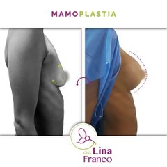 Mamoplastia de aumento - Dra. Lina Franco