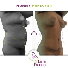 Abdominoplastia + lipoescultura + Lipotransferencia glútea - Dra. Lina Franco