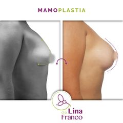 Cirugía de senos tuberosos  - Dra. Lina Franco
