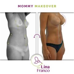 Lipoescultura - Dra. Lina Franco