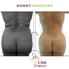 Lipoescultura + Tranferencia de grasa a los glúteos - Dra. Lina Franco