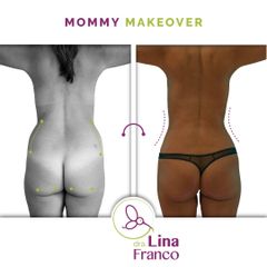 Lipoescultura de cintura y caderas - Dra. Lina Franco
