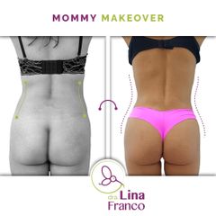 Liposuccion de cintura y espalda - Dra. Lina Franco