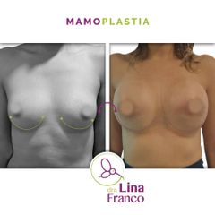 Aumento mamario 380 cc Plano dual - Dra. Lina Franco