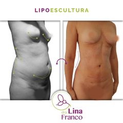 Lipolísis - Liposucción  - Dra. Lina Franco