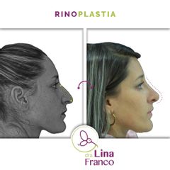 Rinoplastia - Dra. Lina Franco