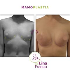 Aumento mamario 260 cc Plano Dual - Dra. Lina Franco