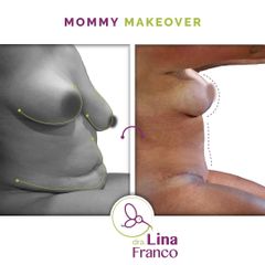 Abdominoplastia  +  Levantamiento de senos con implantes - Dra. Lina Franco