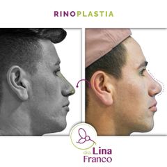 Rinoseptoplastia + Lipoinyeccion facial + Nanopore - Dra. Lina Franco