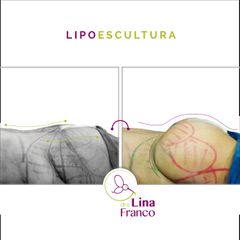 Gluteoplastia - Dra. Lina Franco