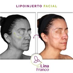 Lipoinjerto facial para rejuvenecer el rostro - Dra. Lina Franco