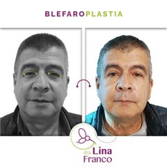 Blefaroplastia - Dra. Lina Franco