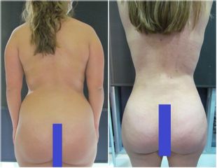 Liposucción - Dr. Juan Carlos Zambrano Burgl