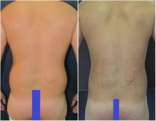 Liposucción - Dr. Juan Carlos Zambrano Burgl