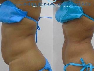 Antes y despues de Tratamiento para la adiposidad localizada y flacidez