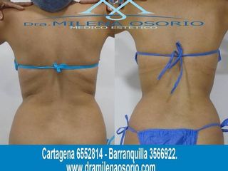 Antes y despues de adis laser